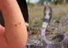 Snake-bite-treatment-tamil