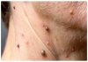 Warts-treatment-hpv-skin-care-tips