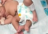 Baby-born-with-four-hands-and-four-legs