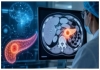 Ai-detects-pancreatic-cancer-early-breakthrough