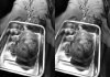 28-year-old-woman-large-uterine-fibroid