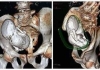 30-years-calcified-fetus-found-in-woman-algeria