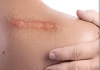 Why woonds getting itching while relaxing
