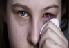 Madras Eye Infection Spreading in Chennai: Health Department Issues Public Advisory 