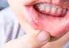 Winter Cold Triggers Rise in Mouth Ulcers and Dehydration 