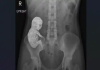 Rare-stone-baby-condition-lithopedion-xray-viral