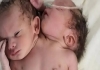 Conjoined-twins-born-in-indore-hospital