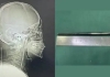 China-man-swallowed-chopstick-removed-after-8-years