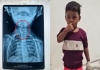 Surat-toddler-swallows-open-safety-pin