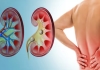 How to recover kidney stone 