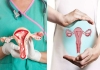 Uterus in male body 