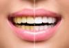 Tips for teeth whitening 