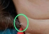 Thailand-woman-throat-fish-bone-viral-incident
