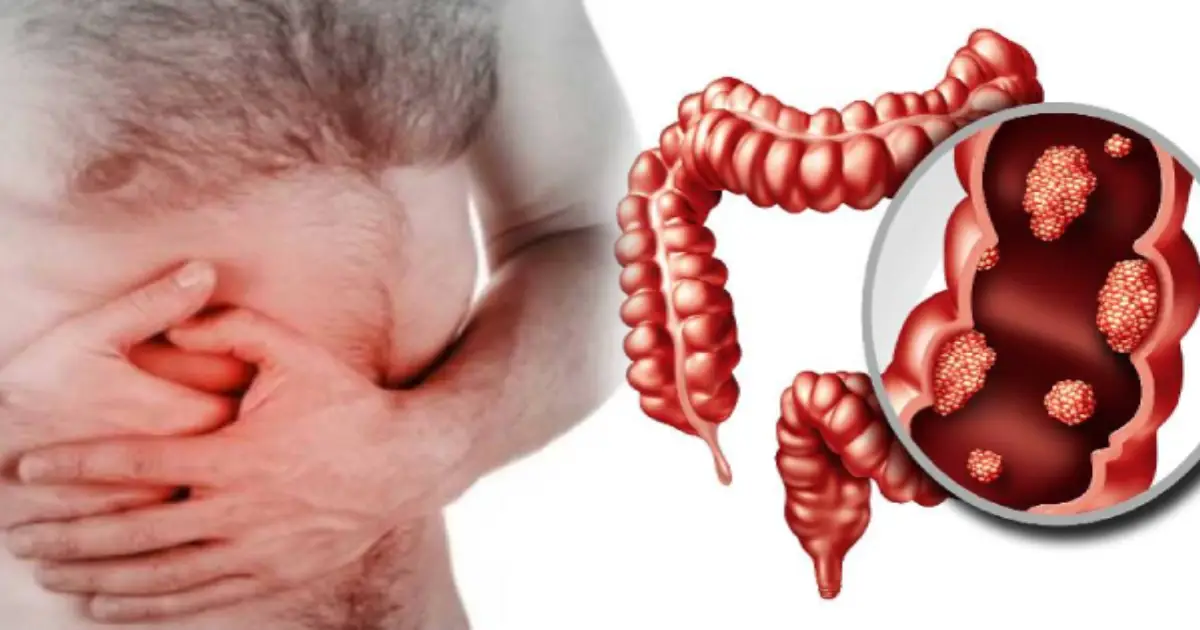 colon-cancer-warning-signs-who
