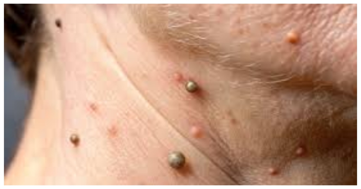 warts-treatment-hpv-skin-care-tips