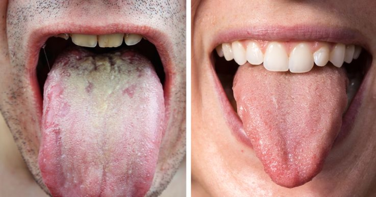 tongue-color-health-warning-signs