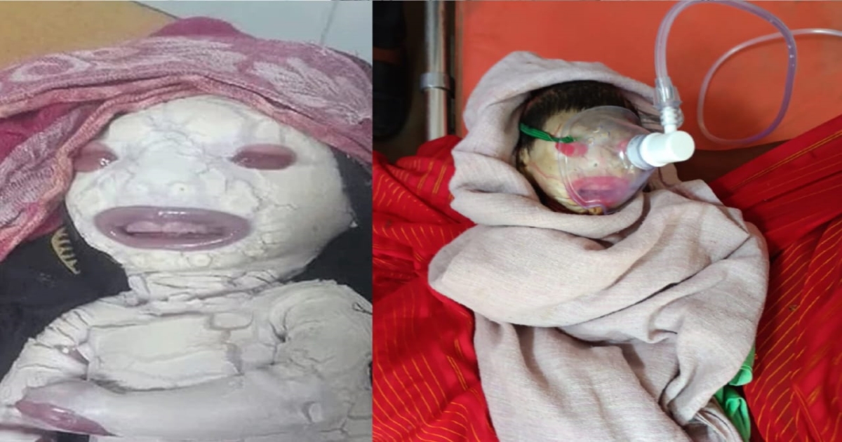 rare-skin-disorder-baby-born-in-madhya-pradesh