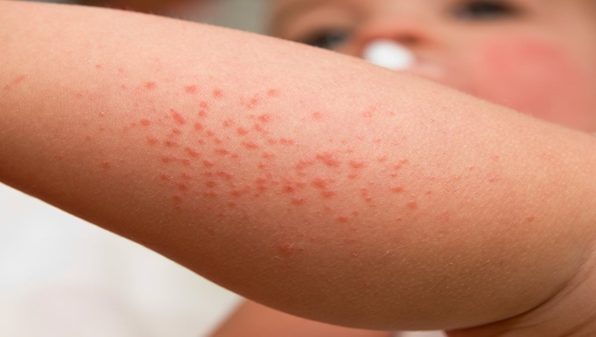 Baby Skin Rashes Problem and Prevention Methods 