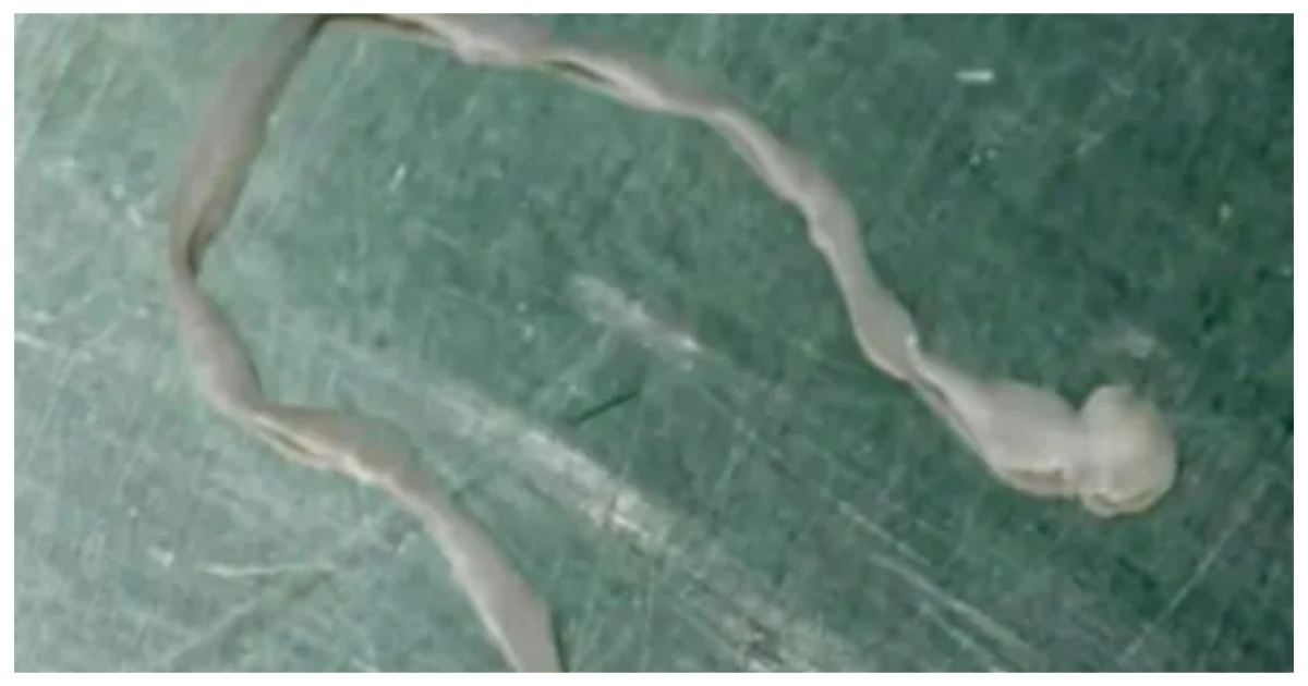 brain-worm-headache-surgery-case