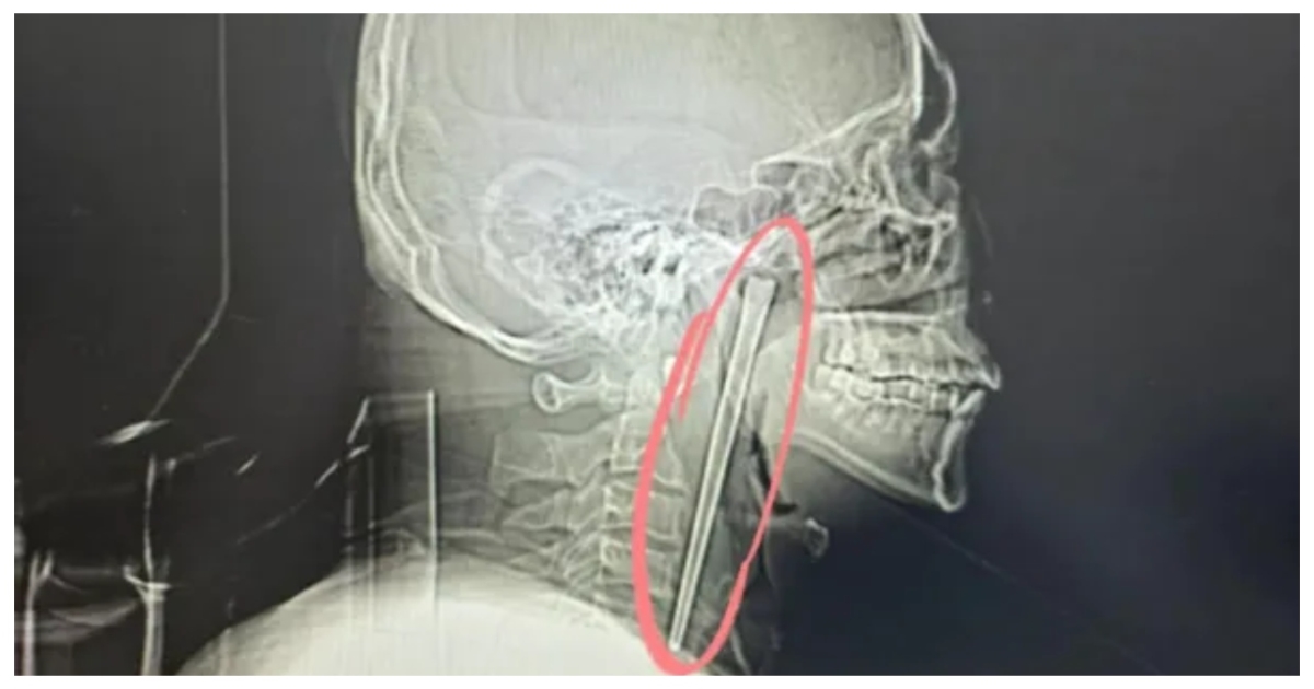 man-throat-pain-xray-metal-object-surgery