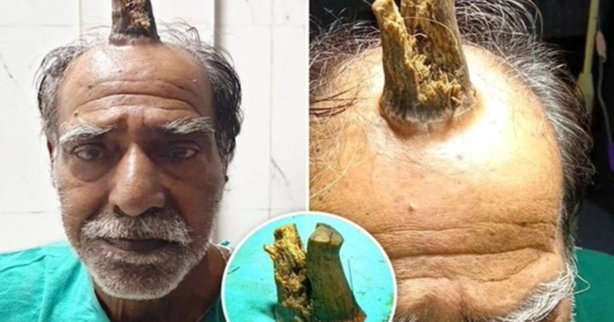 madhya-pradesh-man-devils-horn-rare-surgery-case