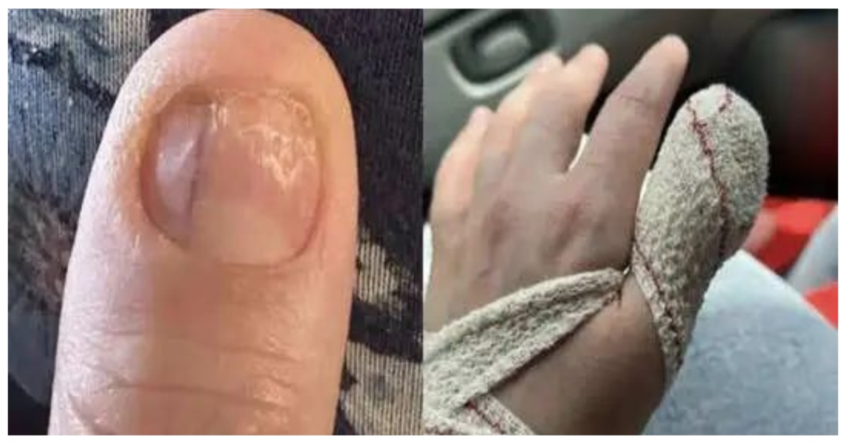 nail-mark-cancer-warning