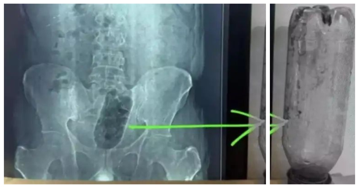 agra-man-inserts-water-bottle-surgery-psychosexual-diso