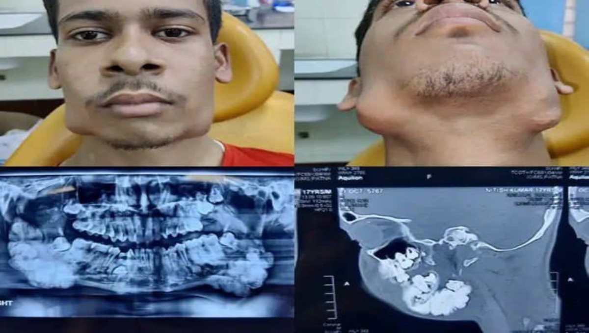 Bihar teenager with rare tumour has 82 teeth removed from his jaw