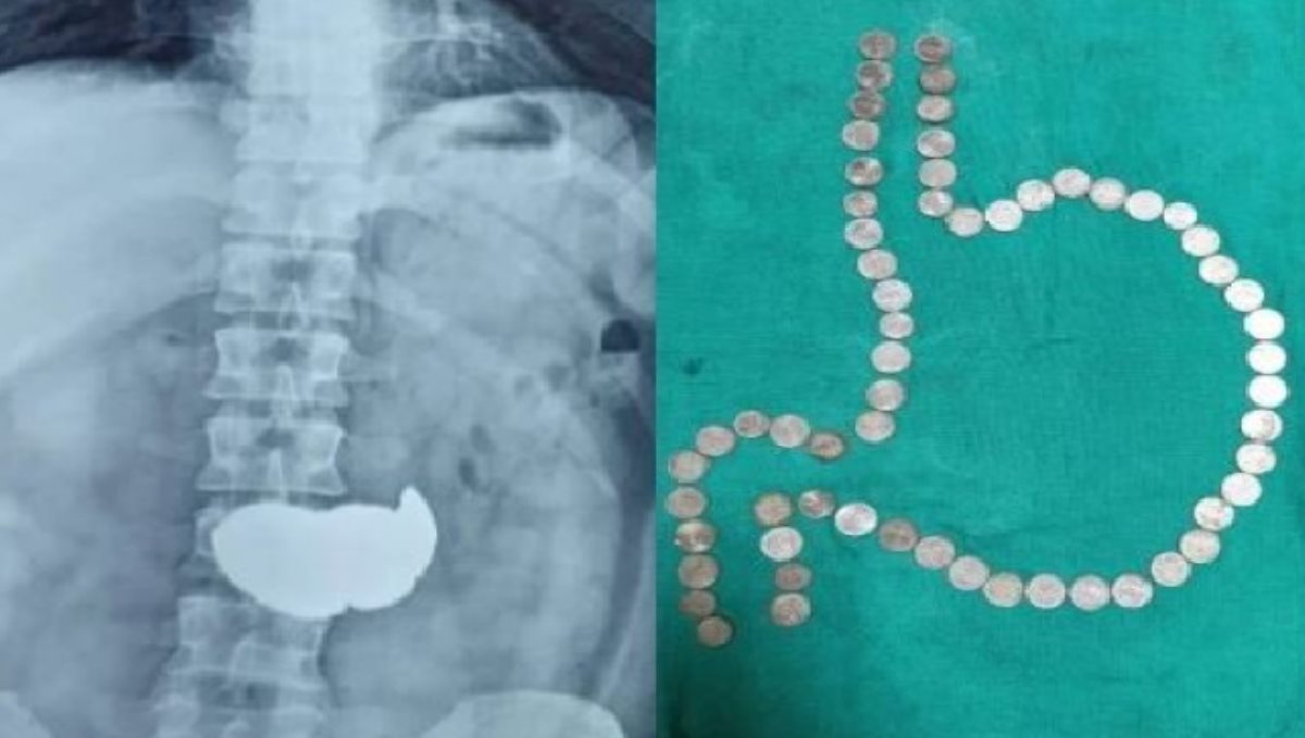 Rajasthan Jaipur Youngster Ate Rs 1 Coin 61 Removed Form Stomach 