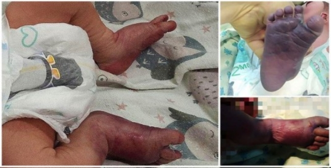 baby-leg-broken-while-delivery-in-russia