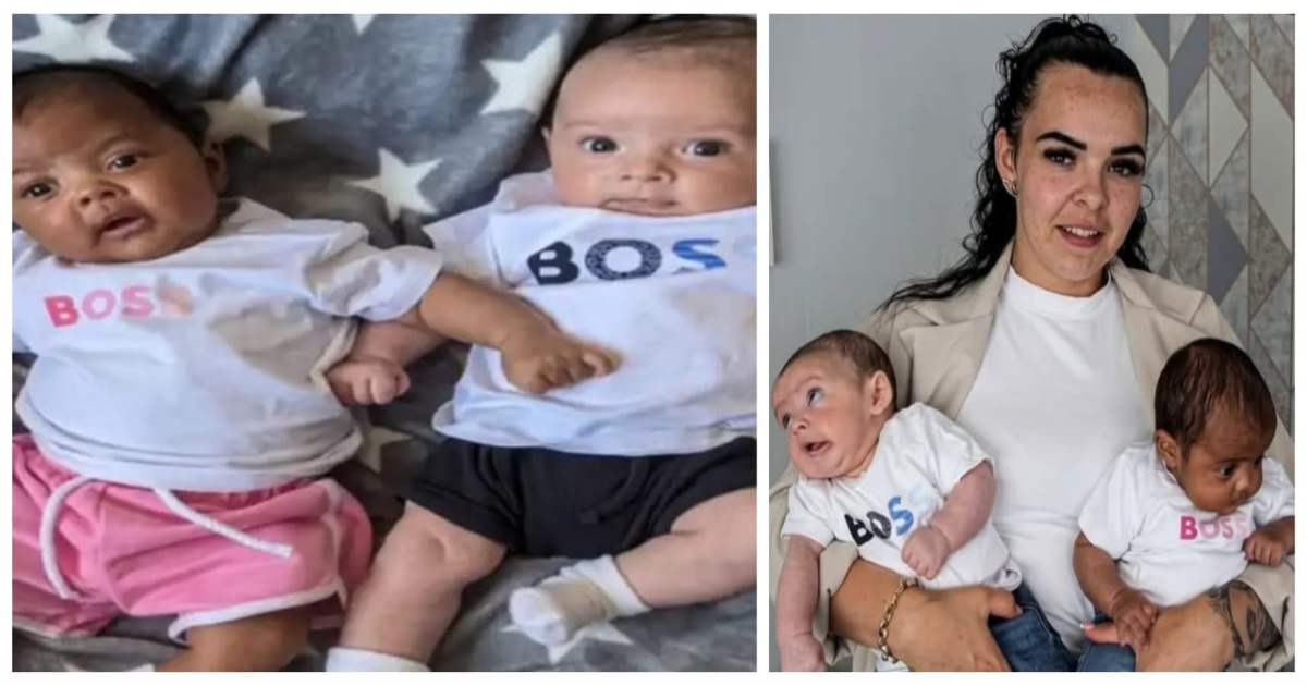 brazil-twins-different-fathers-rare-medical-case