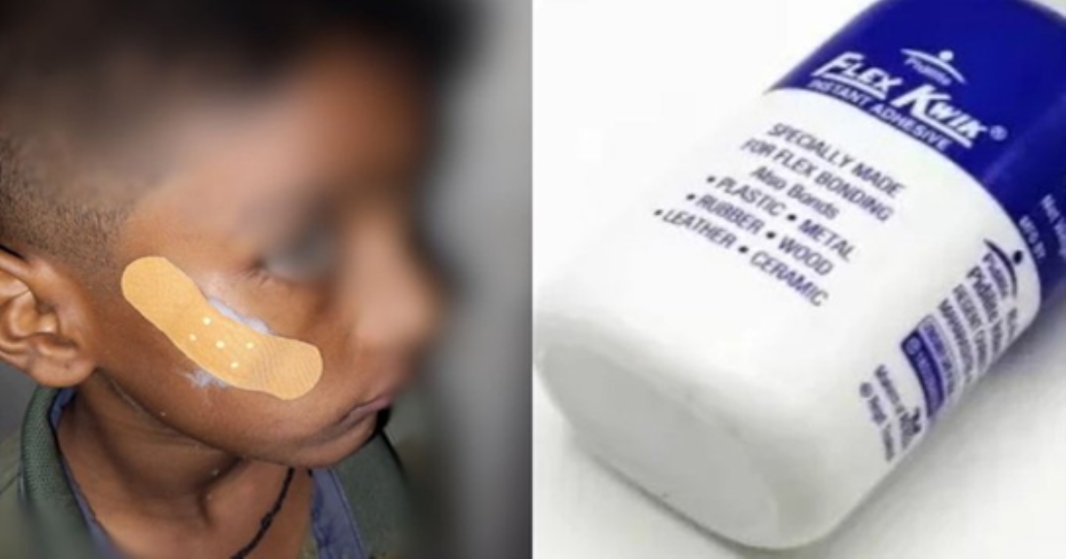 in Karnataka Nurse Treatment to child With Fevikwik