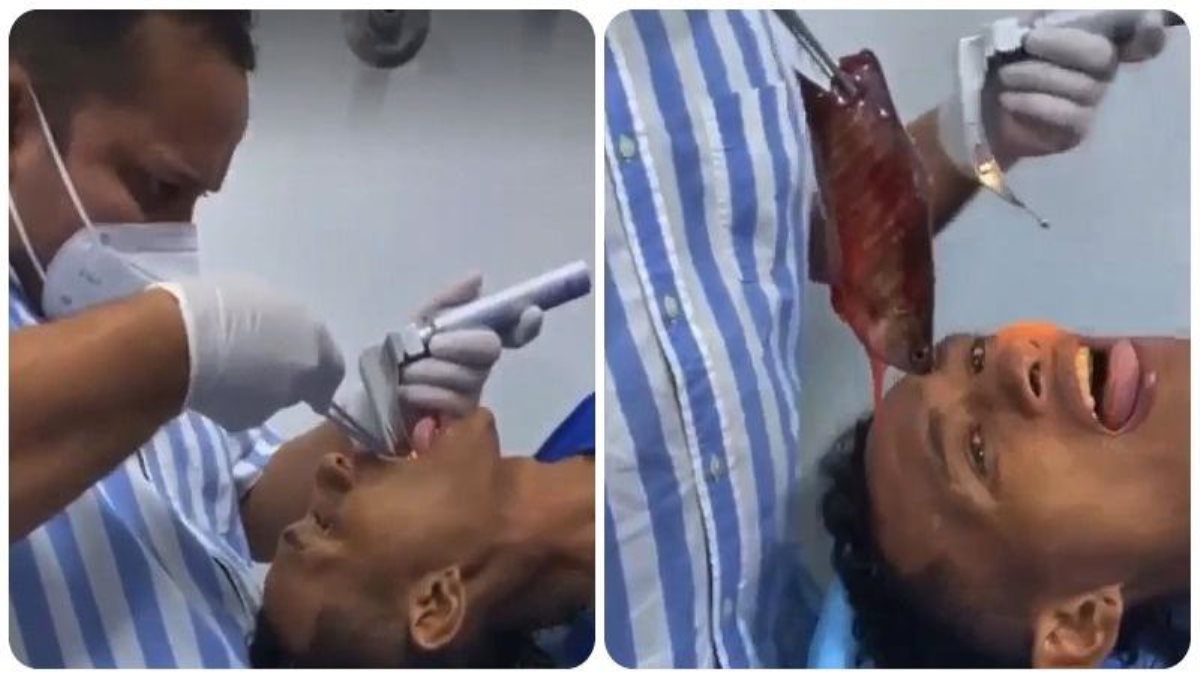 Doctors Pull Out 7-Inch Fish From A Mans Throat