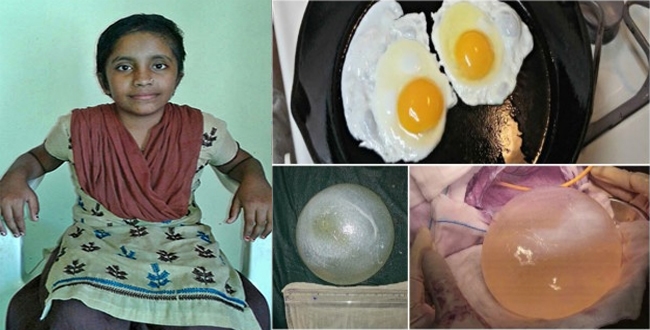tapeworm-eggs-found-in-girl-brain-near-delhi