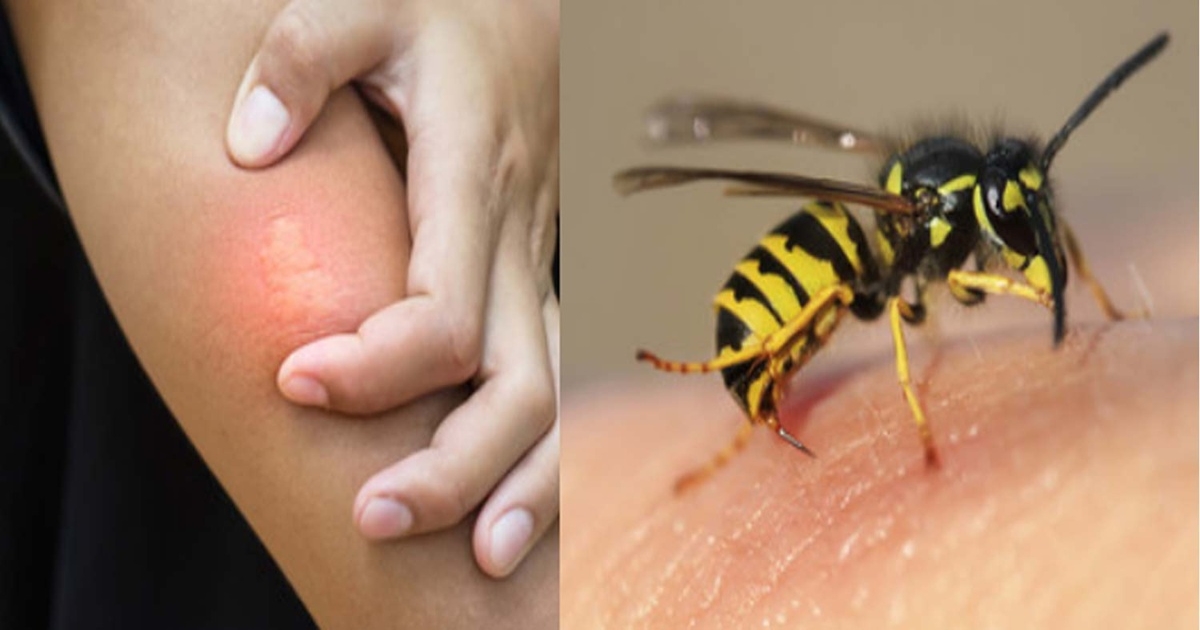 Bee-and-Wasp-Sting-First-Aid-Symptoms-What-To-Do-And-Avoid