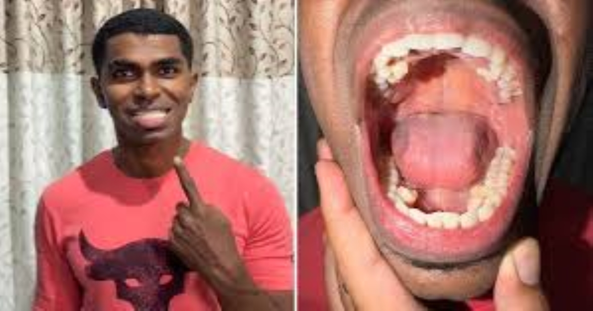 malaysia-man-with-42-teeth-guinness-world-record