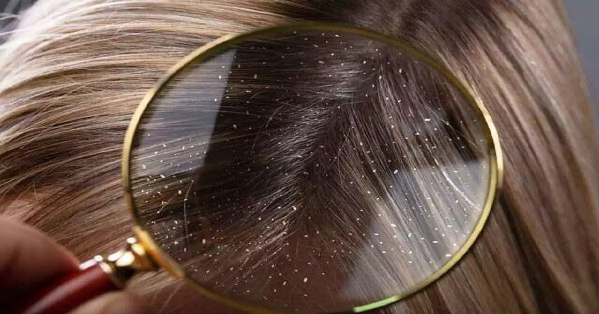 Best remedy dor dandruff