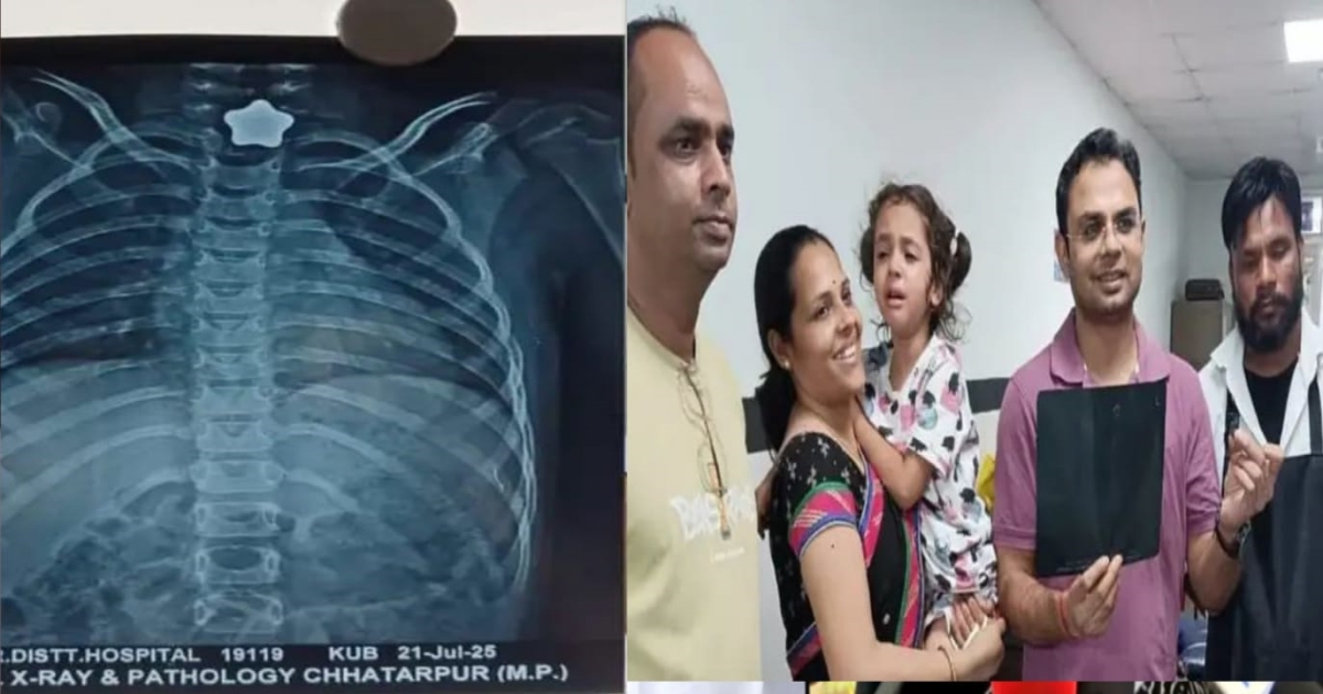 girl-swallows-magnet-madhya-pradesh