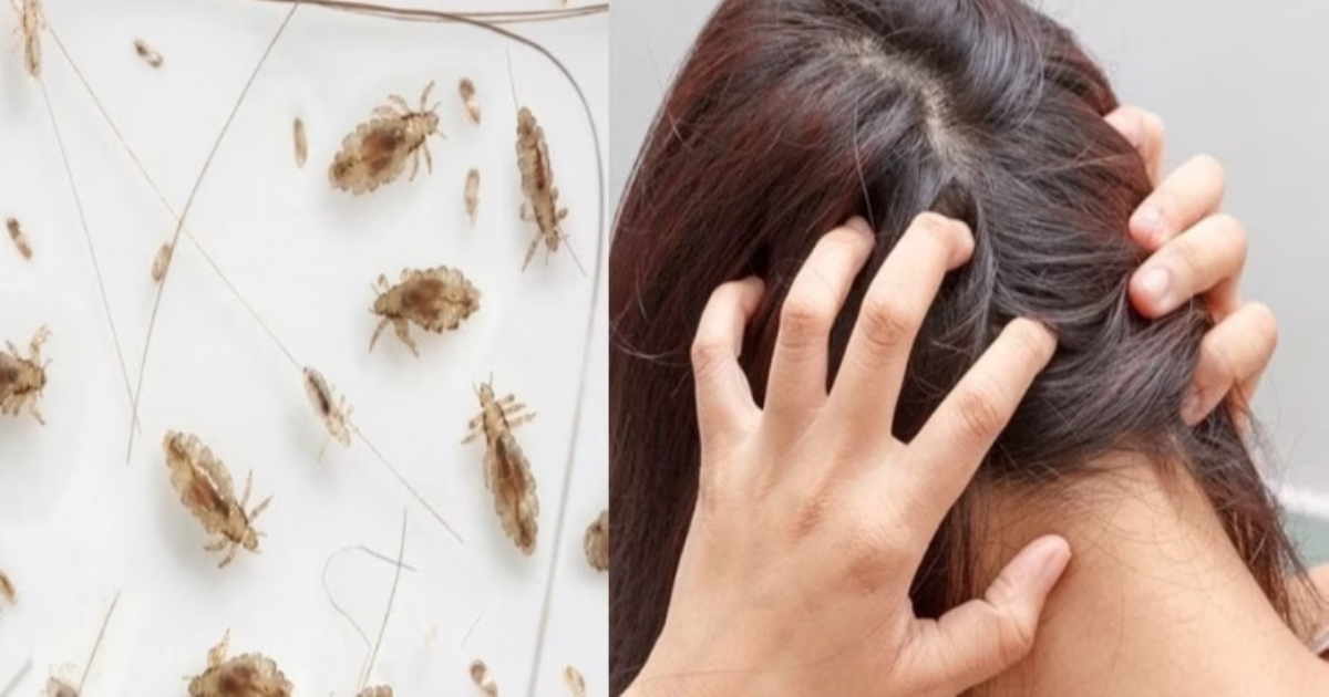 Home remedies for cure lice