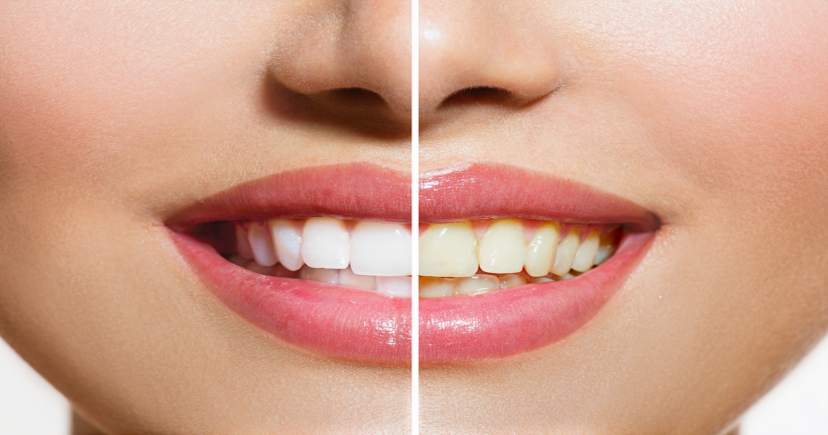 How to make yellow teeth to white tips in tamil