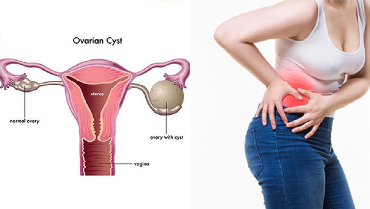 Uterine cyst How to Identify Tamil 