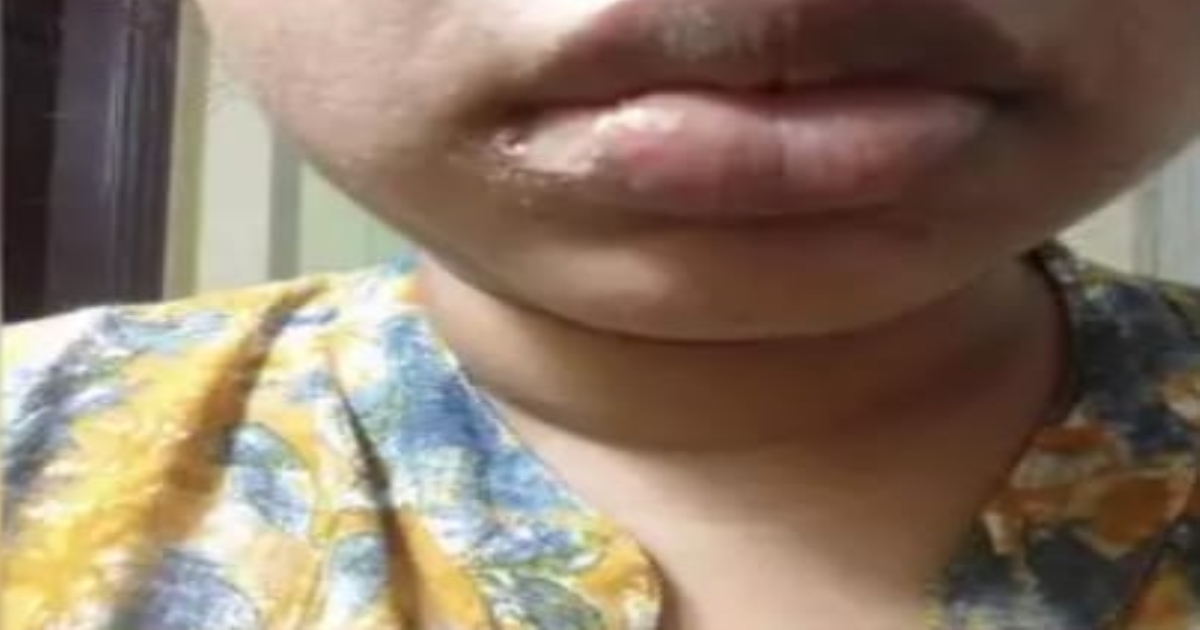 Telangana Hyderabad Women Lip chopped by Dentist 