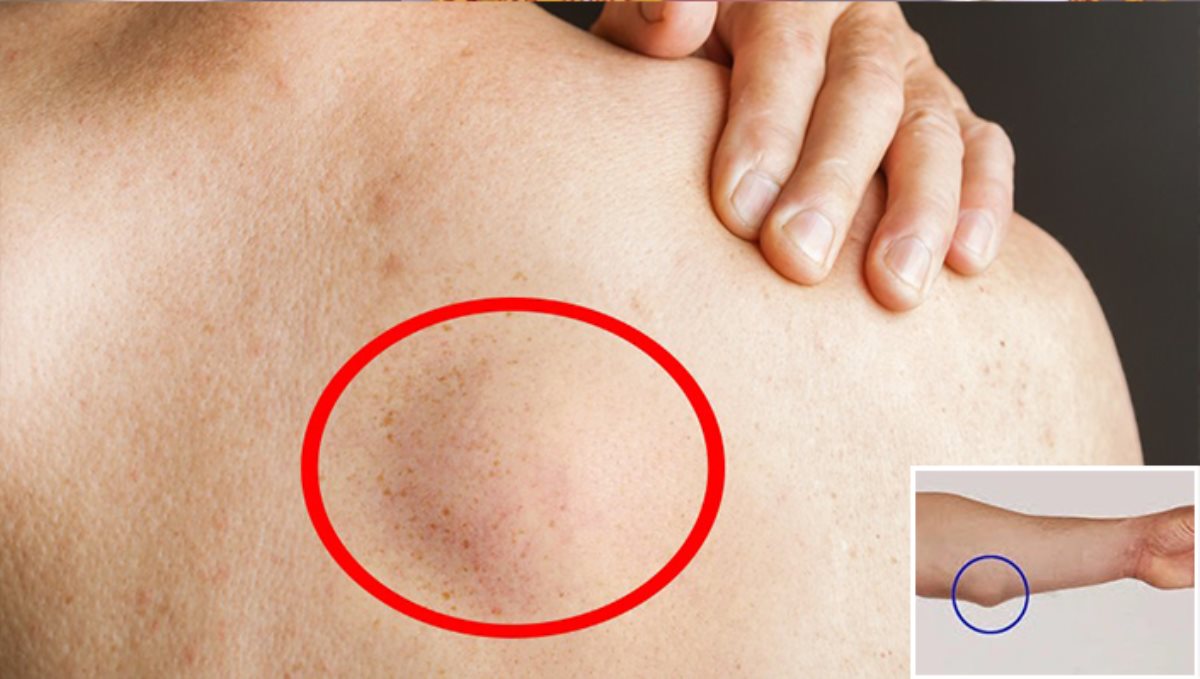 tips-about-lipoma-fat-tumors-in-tamil