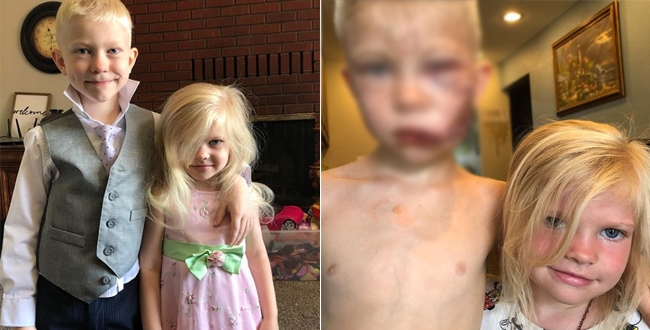 Dog bite small boy who tried to save his sister
