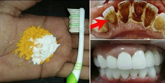 Home remedies for whitening teeth in tamil