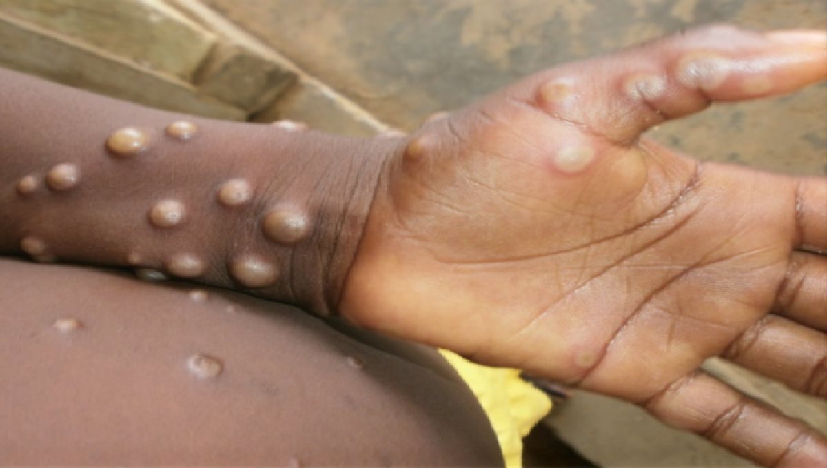 england-confirm-nigeria-return-man-affect-chickenpox