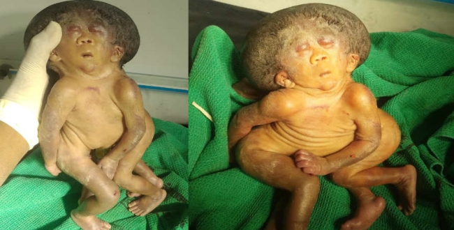mysterious-twin-babies-born-in-krishnagiri-govt-hospita