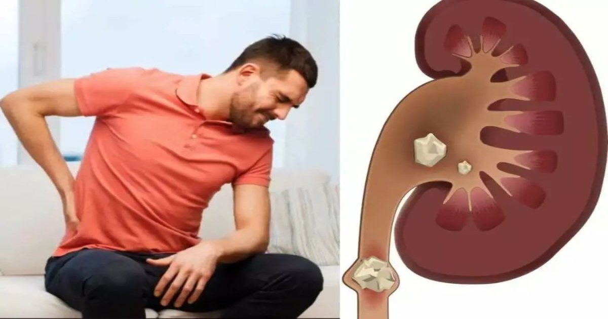 You won't believe it.. Drink this and all the stones in the kidney will dissolve and come out immediately..!
