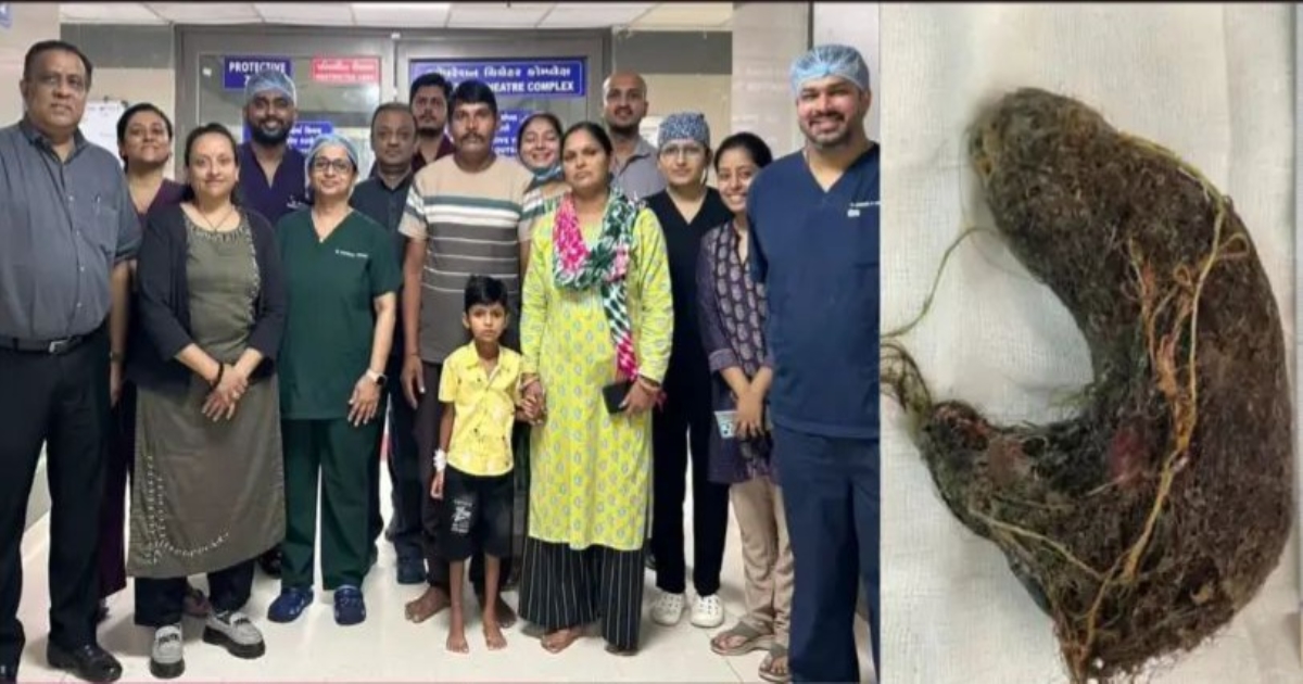 ahmedabad-trichobezoar-surgery-2025