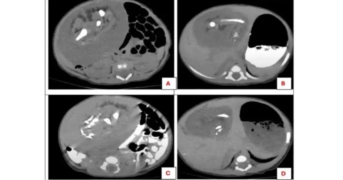 rare-fetus-in-fetu-case-egypt-baby-surgery